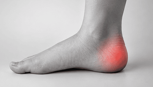 Ziekte Van Sever - Zottegem - Orthopedie - Kinderorthopedie