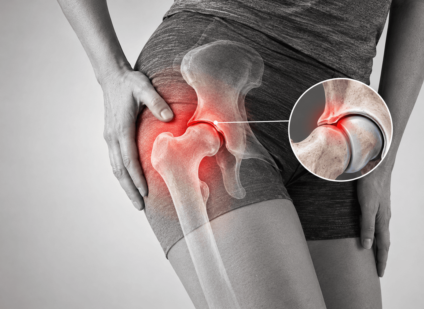 Femoroacetabulair Impingement - Orthopedie Zottegem